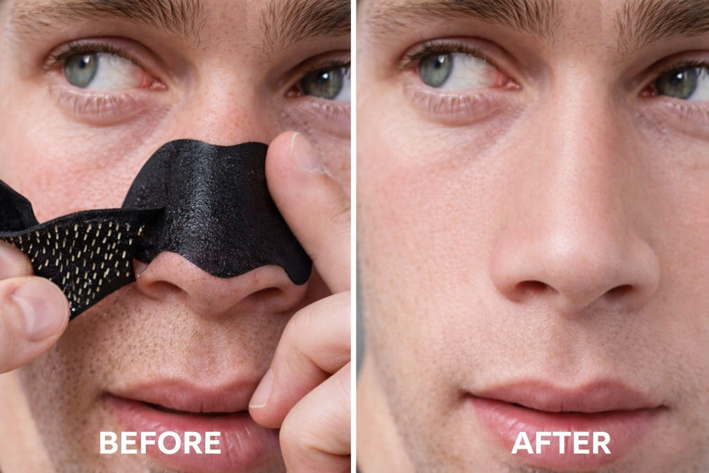 Blackhead Removal Nose Strips